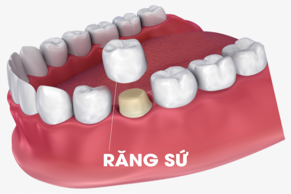 Chi phí làm răng sứ thẩm mỹ Thái Bình có đắt không? Xem ngay!