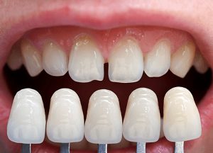 Bọc răng sứ thẩm mỹ Thái Bình giá rẻ chất lượng cao, chi phí hợp lý