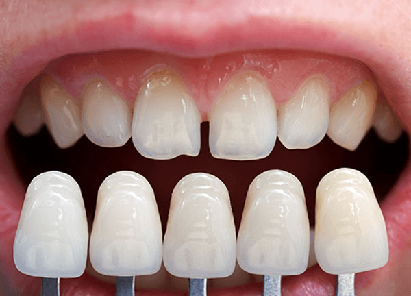 Làm răng sứ thẩm mỹ Thái Bình chính hãng