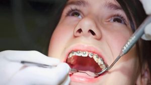 Niềng răng bị hôi miệng - guyên nhân và cách xử lý hiệu quả
