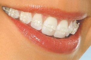 Nha khoa lâu năm niềng răng Thái Bình - Kinh nghiệm tạo nên chất lượng