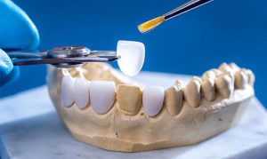 Vì sao nên chọn bọc răng sứ nha khoa uy tín 75 năm? Bí quyết sở hữu hàm răng đẹp