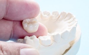 Kinh nghiệm làm răng sứ thẩm mỹ cho người lớn tuổi không đau, hiệu quả cao