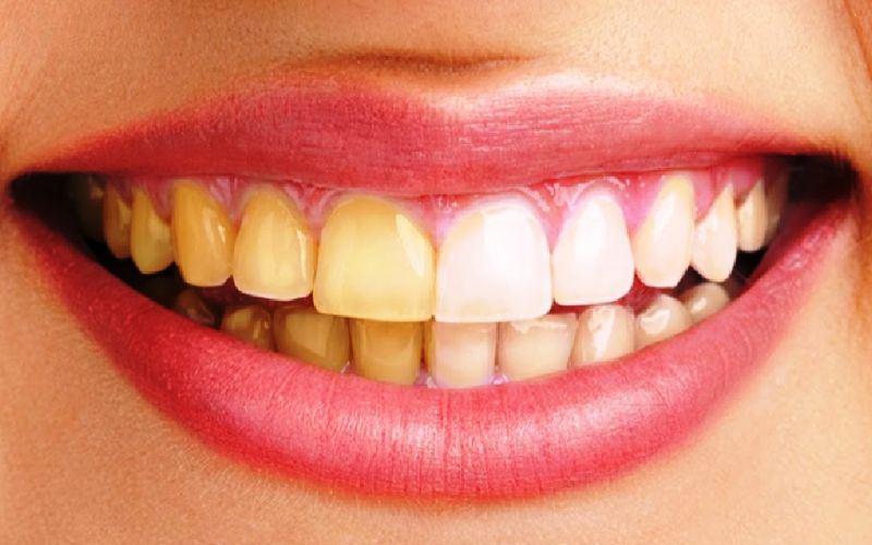 5 lý do bạn nên làm răng sứ thẩm mỹ cho răng ố vàng nặng ngay hôm nay