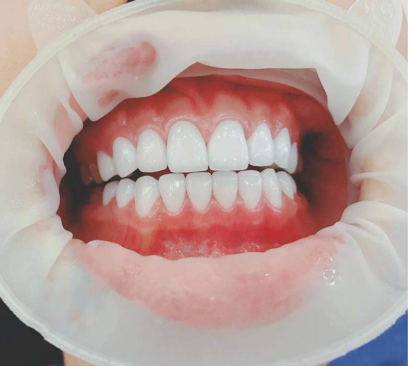 Bọc răng sứ thẩm mỹ có đau không? Nguyên nhân gây đau khi làm răng