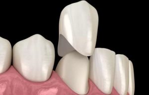 Vì sao nên chọn bọc răng sứ nha khoa uy tín 75 năm? Bí quyết sở hữu hàm răng đẹp
