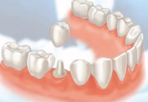 Bọc răng sứ thẩm mỹ có đau không? Nguyên nhân gây đau khi làm răng