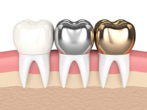 Bọc răng sứ thẩm mỹ - Lựa chọn hoàn hảo cho nụ cười đẹp