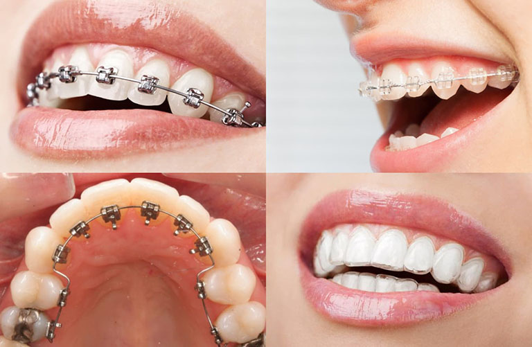 Bật mí địa chỉ niềng răng ở đâu tốt tại Thái Bình được nhiều người lựa chọn