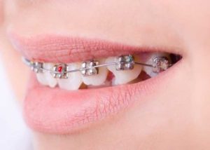 Niềng răng khấp khểnh nhẹ Thái Bình - Khi nào nên niềng để đạt hiệu quả cao?