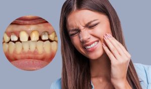 Cảnh báo 6 hậu quả nghiêm trọng của việc bọc răng sứ giá rẻ kém chất lượng