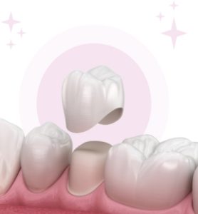 Bọc răng sứ thẩm mỹ - Lựa chọn hoàn hảo cho nụ cười đẹp