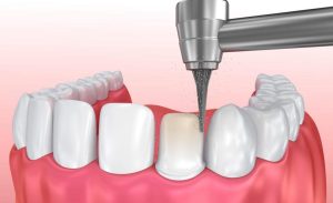 Bọc răng sứ thẩm mỹ Thái Bình giá rẻ chất lượng cao, chi phí hợp lý