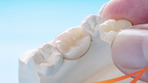 Kinh nghiệm làm răng sứ thẩm mỹ cho người lớn tuổi không đau, hiệu quả cao