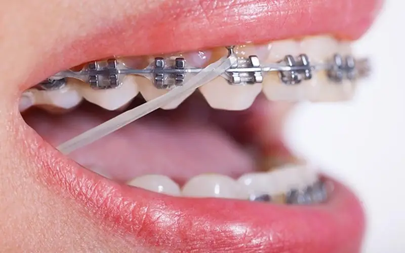 Địa chỉ nha khoa niềng răng uy tín ở Thái Bình