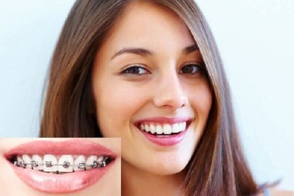 Niềng răng có bị hóp má không? Nguyên nhân và cách khắc phục hiệu quả