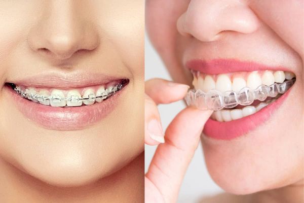 Niềng răng có bị hóp má không? Nguyên nhân và cách khắc phục hiệu quả