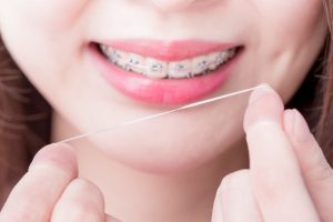 Sự thật về niềng răng tại Thái Bình có đau không bạn cần biết