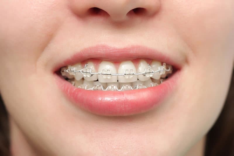 Thời gian niềng răng hô nhẹ mất bao lâu? Có nhanh không?