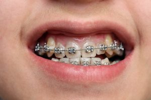 Niềng răng khấp khểnh nhẹ Thái Bình - Khi nào nên niềng để đạt hiệu quả cao?