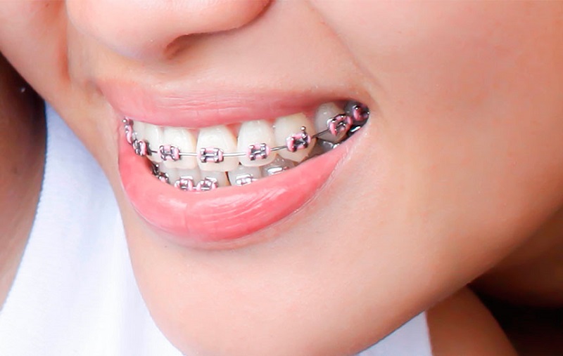 Sự thật về niềng răng tại Thái Bình có đau không bạn cần biết