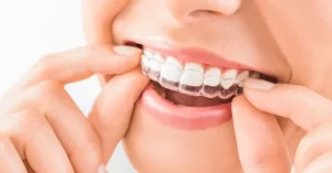 Thời gian niềng răng hô nhẹ mất bao lâu? Có nhanh không?