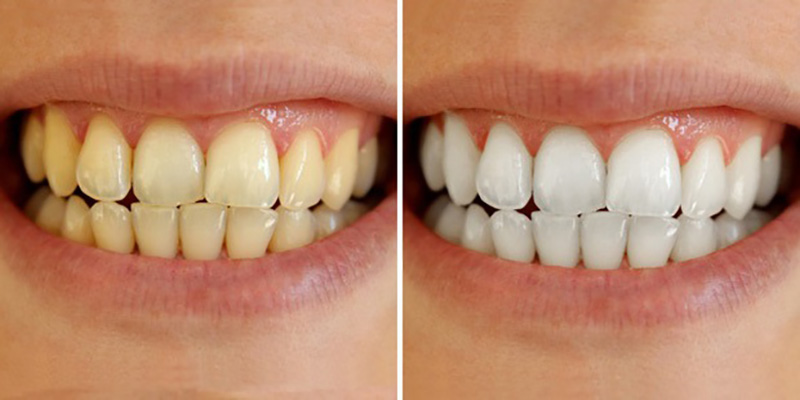 5 lý do bạn nên làm răng sứ thẩm mỹ cho răng ố vàng nặng ngay hôm nay