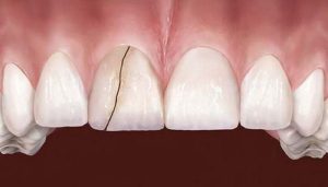Cảnh báo 6 hậu quả nghiêm trọng của việc bọc răng sứ giá rẻ kém chất lượng