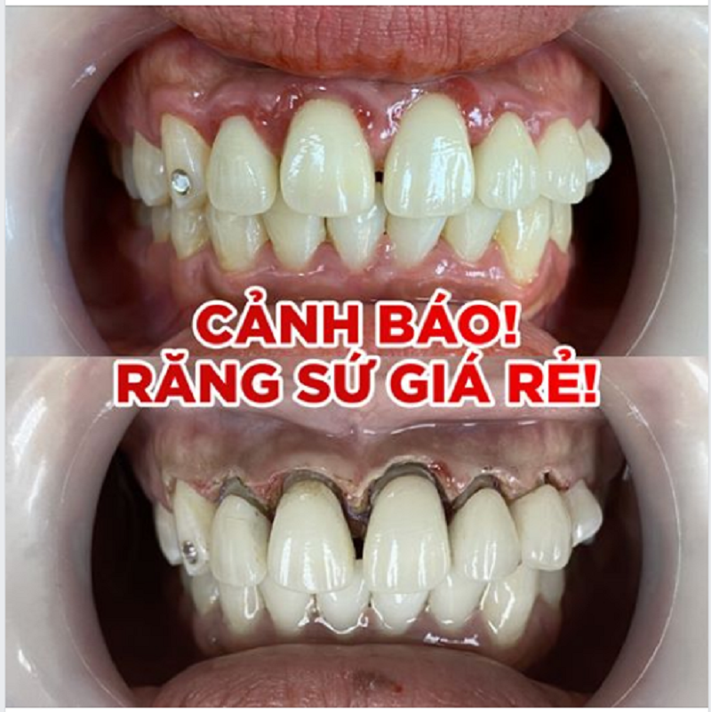 Cảnh báo 6 hậu quả nghiêm trọng của việc bọc răng sứ giá rẻ kém chất lượng