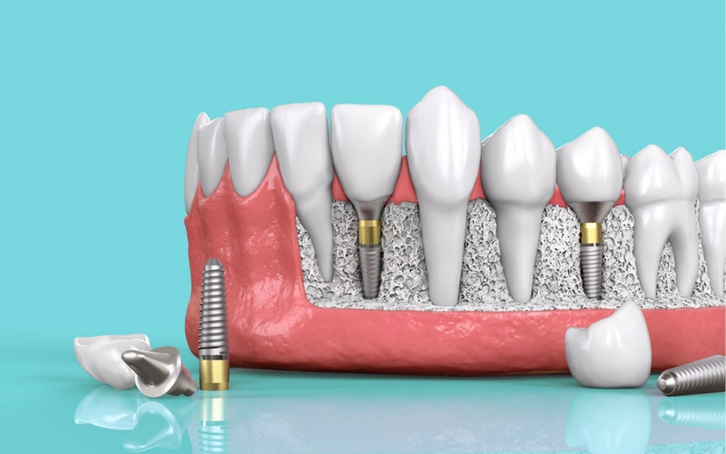 Bọc răng sứ thẩm mỹ có đau không? Nguyên nhân gây đau khi làm răng
