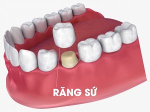 Bọc răng sứ thẩm mỹ - Lựa chọn hoàn hảo cho nụ cười đẹp