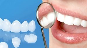 Vì sao nên chọn bọc răng sứ nha khoa uy tín 75 năm? Bí quyết sở hữu hàm răng đẹp