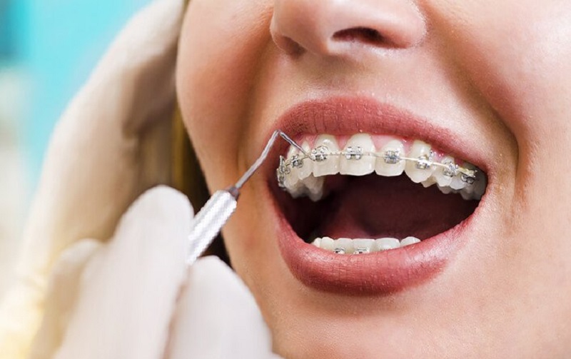 Địa chỉ nha khoa niềng răng uy tín ở Thái Bình