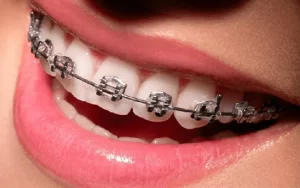 Niềng răng 1 hàm có được không? Những ai phù hợp để thực hiện