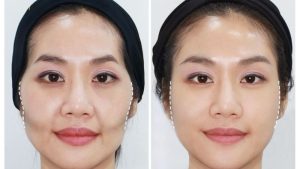 Niềng răng có bị hóp má không? Nguyên nhân và cách khắc phục hiệu quả