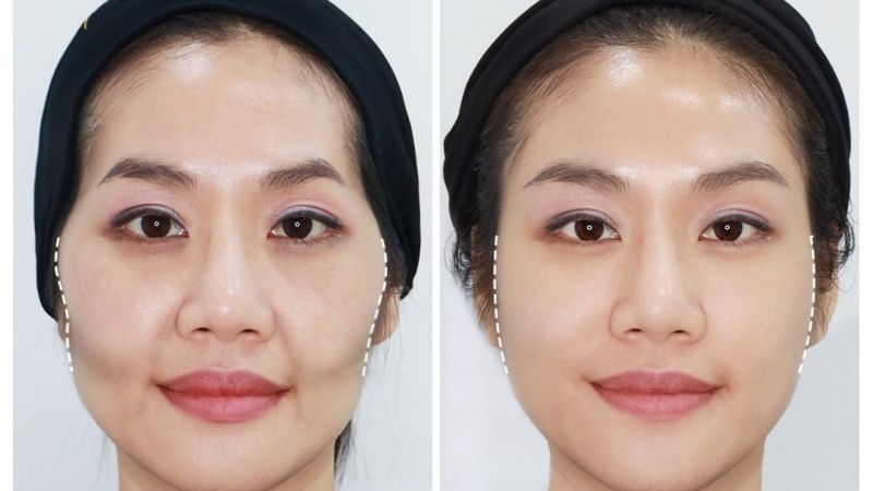 Niềng răng có bị hóp má không? Nguyên nhân và cách khắc phục hiệu quả