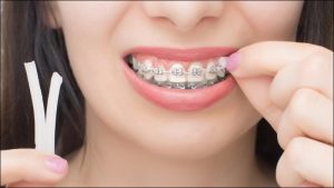 Sự thật về niềng răng tại Thái Bình có đau không bạn cần biết