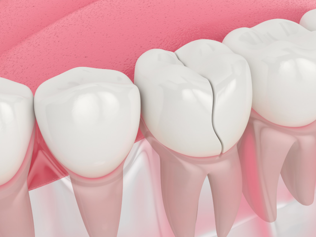 Cảnh báo 6 hậu quả nghiêm trọng của việc bọc răng sứ giá rẻ kém chất lượng