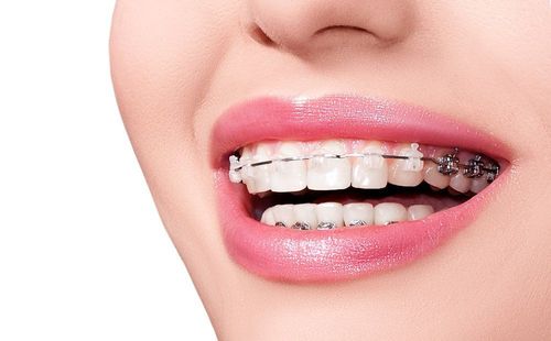 Niềng răng khấp khểnh nhẹ Thái Bình - Khi nào nên niềng để đạt hiệu quả cao?